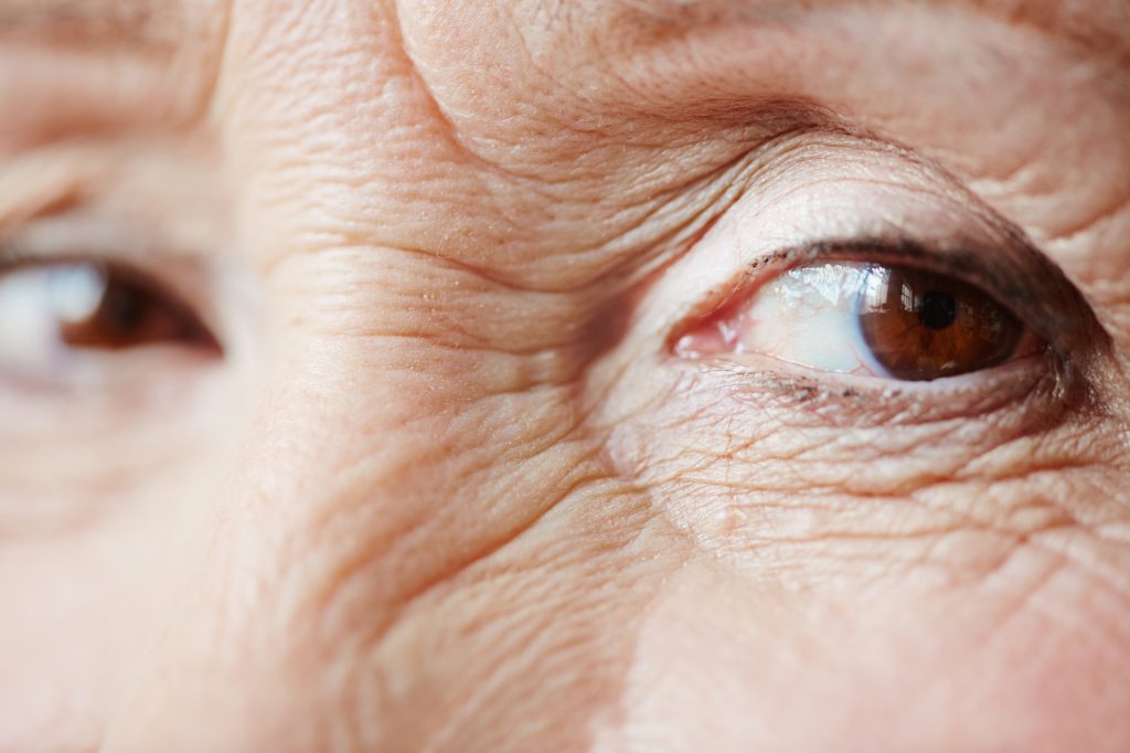 hooded eyelid