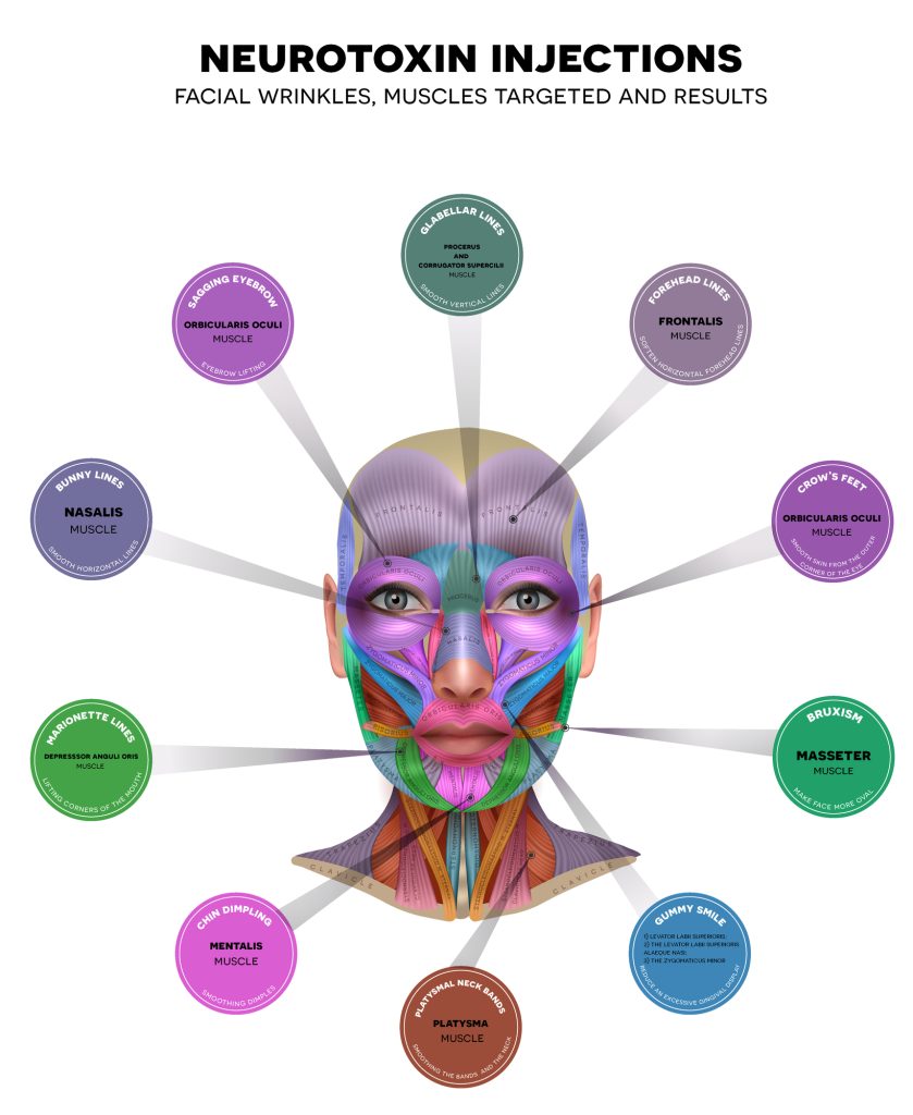 A thorough understanding of facial anatomy and exacting skill are necessary for administering Botox.