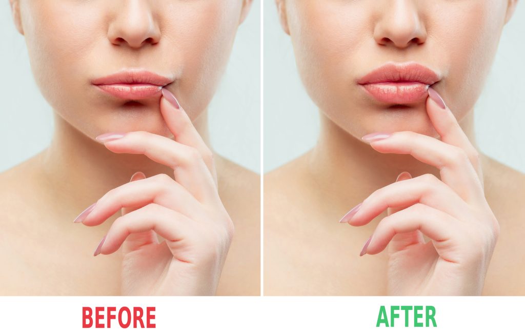 Injectable dermal fillers can fill hollow regions, reduce fine lines and wrinkles, and perfect the face. 