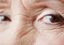 Are Hooded Eyes Treatable with Botox?
