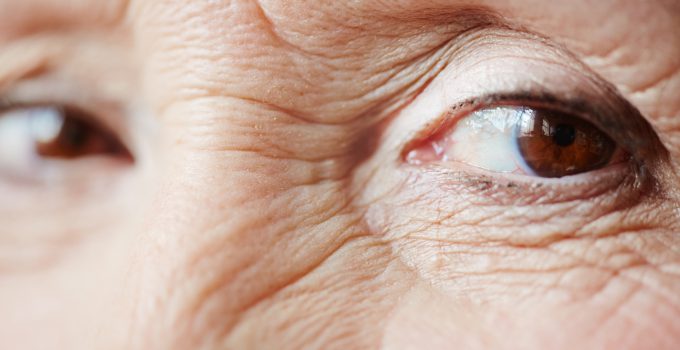 Are Hooded Eyes Treatable with Botox? Are Hooded Eyes Treatable with Botox?