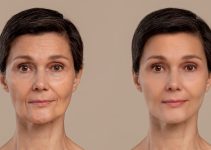 Deciphering the Path: A Comprehensive Exploration of Dermal Filler Treatments and Their Effects Deciphering the Path: A Comprehensive Exploration of Dermal Filler Treatments and Their Effects