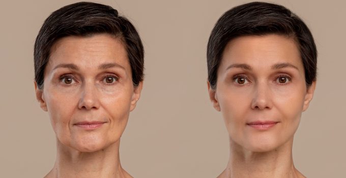 Deciphering the Path: A Comprehensive Exploration of Dermal Filler Treatments and Their Effects Deciphering the Path: A Comprehensive Exploration of Dermal Filler Treatments and Their Effects