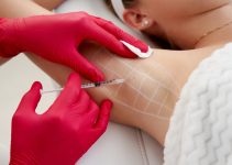 How to Get Botox Under Your Arms: A Comprehensive Guide How to Get Botox Under Your Arms: A Comprehensive Guide