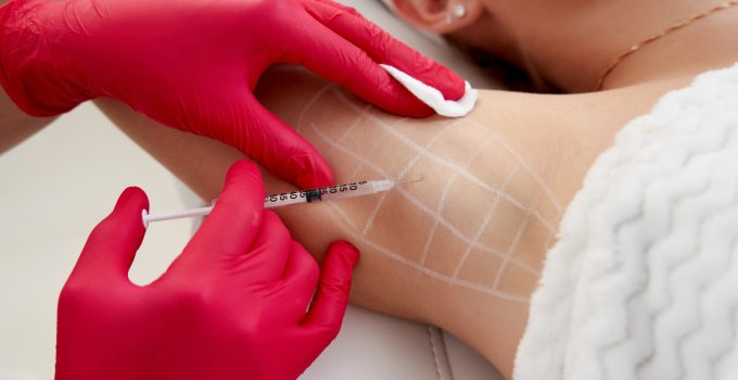 How to Get Botox Under Your Arms: A Comprehensive Guide