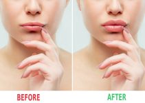 Achieving Fuller Lips with Dermal Fillers