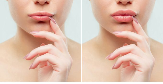 Achieving Fuller Lips with Dermal Fillers